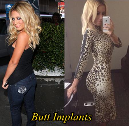 Aubrey O Day Butt Implants 8