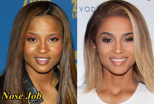 Ciara-Plastic-Surgery-Before-and-After-Nose-Job.jpg