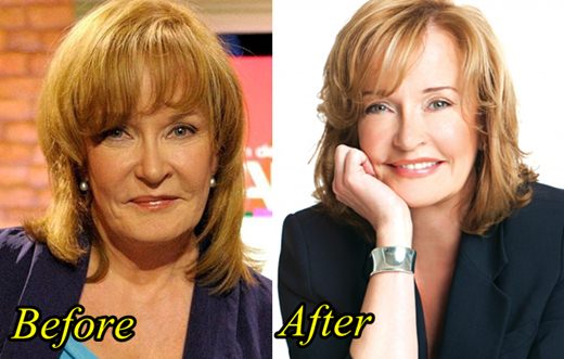 Marilyn Denis Plastic Surgery Before and After Picture - Marilyn-Denis-Plastic-Surgery-Before-and-After-Picture