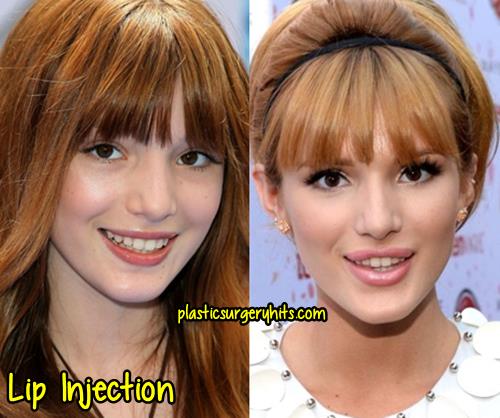 Bella Thorne Plastic Surgery Before And After.