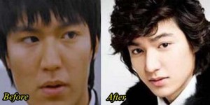 Lee Min Ho Plastic surgery Before and After Pictures