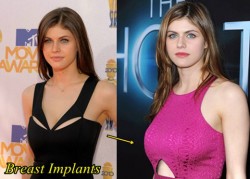 Alexandra Daddario Plastic Surgery Before and After Breast Implants