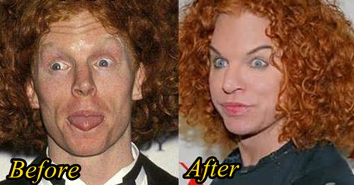 Carrot Top Plastic Surgery Before After