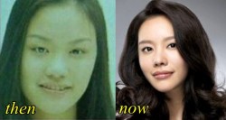 Kim Ah Joong Plastic Surgery
