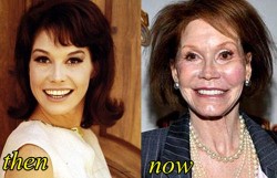 Mary Tyler Moore Plastic Surgery Before and After