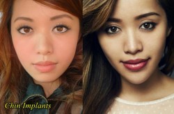 Michelle Phan Plastic Surgery Before and After
