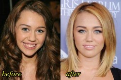 Miley Cyrus Plastic Surgery Before After Teeth Surgery and Nose Job