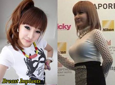Park Bom Breast Implants