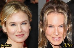 Renee Zellweger Plastic Surgery Before and After