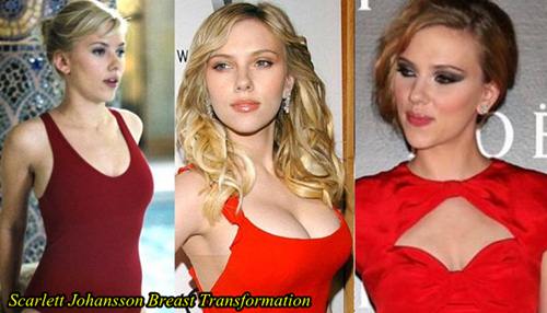 Scarlett Johansson Plastic Surgery, Nose Job, Breast implants.