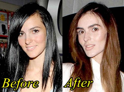 Ali Lohan Plastic Surgery Before and After