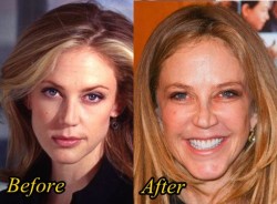 Ally Walker Plastic Surgery Before and After