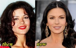 Catherine Zeta Jones Plastic Surgery Before and After