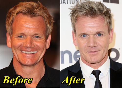 Gordon Ramsay Plastic Surgery Before and After