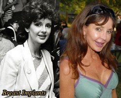 Jackie Zeman Plastic Surgery Before and After
