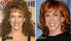 Kathy Griffin Plastic Surgery Before and After