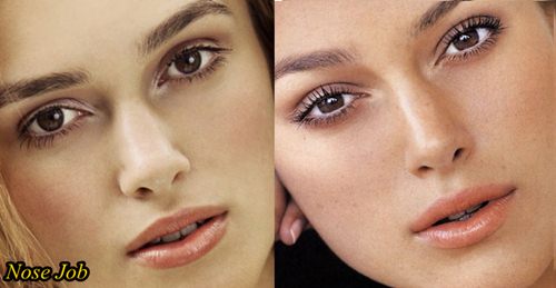 Keira Knightley Plastic Surgery Before and After Nose Job