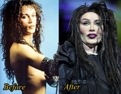 Pete Burns Plastic Surgery Gone Wrong