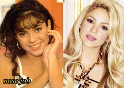 Shakira Plastic Surgery Before and After Nose Job