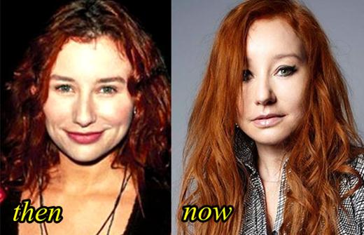 Tori Amos Plastic Surgery Before and After Picture