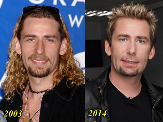Chad Kroeger Plastic Surgery Before and After