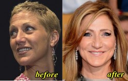 Edie Falco plastic Surgery Before and After