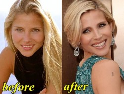 Elsa Pataky Plastic Surgery Before and After
