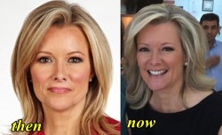 Gerri Willis Plastic Surgery Before and After