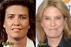 Greta van Susteren Plastic Surgery Before and After
