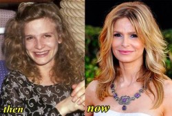 Kyra Sedgwick Plastic Surgery Before and After
