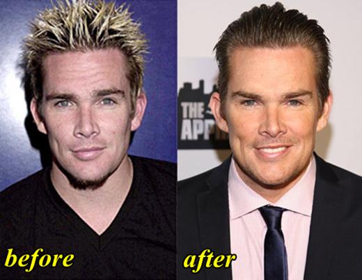 Mark McGrath Plastic Surgery Before and After. 