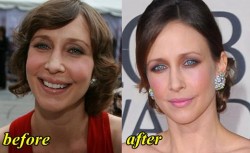 Vera Farmiga Plastic Surgery Before and After