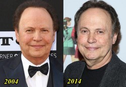 Billy Crystal Plastic Surgery Before and After