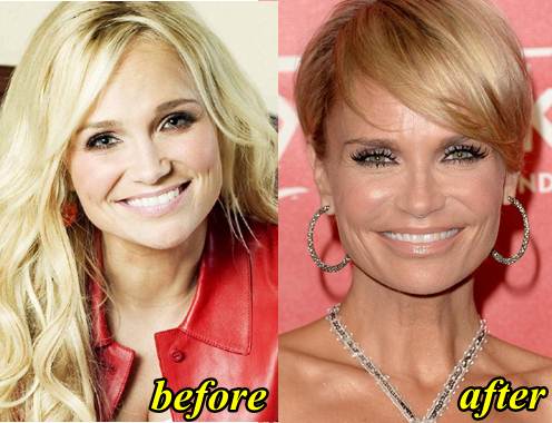 Kristin Chenoweth Plastic Surgery Before and After.