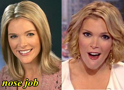 Megyn Kelly Nose Job Before and After