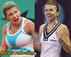 Simona Halep Breast Reduction - Plastic Surgery before and After