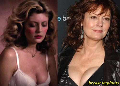 Susan Sarandon Breast Implants.