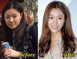 Seo Ji Hye Plastic Surgery