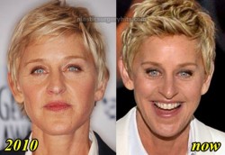 Ellen DeGeneres Plastic Surgery Before and After