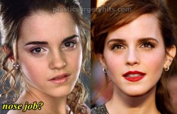 Emma Watson Plastic Surgery Nose Job