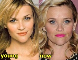 Reese Witherspoon Plastic Surgery Fact or Rumor
