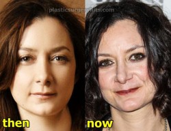 Sara Gilbert Plastic Surgery Before and After