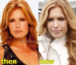 Tracey Bregman Plastic Surgery Before and After