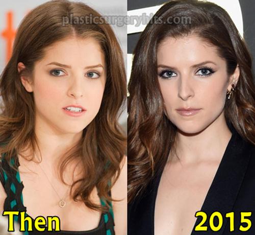 Anna Kendrick Plastic Surgery Fact or Just a Pure Rumor? 