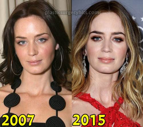 Emily Blunt Plastic Surgery Before and After. 
