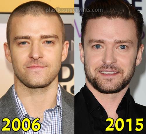 Justin Timberlake Plastic Surgery fact or Rumor