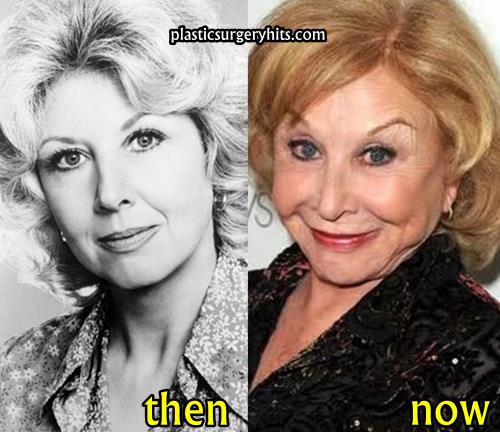Michael Learned Plastic Surgery Before and After