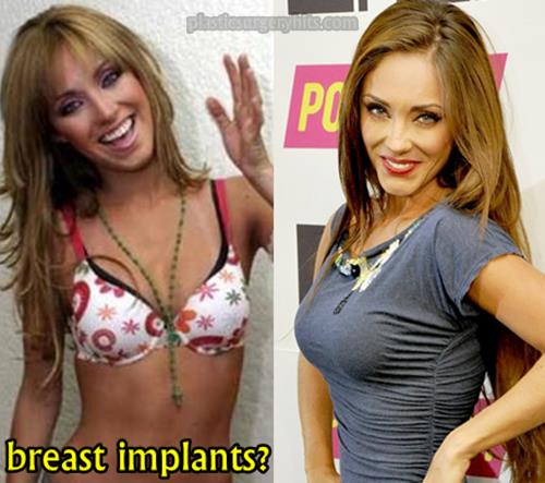 Anahi Breast Implants