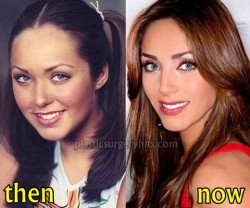 Anahi Plastic Surgery Before an After