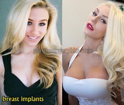 Courtney Stodden Breast Implants